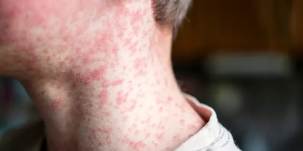 Alarme contra o sarampo nas Américas: mais de 10 mil casos e 18 óbitos