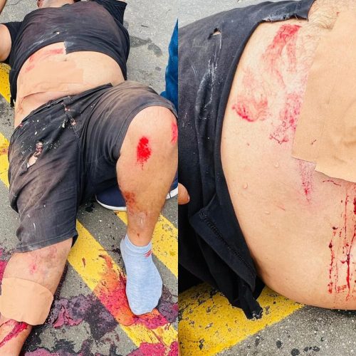 Em Cruzeiro do Sul, acidente na estrada da UFAC deixa motociclista ferido no Bairro Boca da Alemanha
