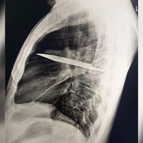 Homem sente dor no peito e descobre faca alojada no corpo há oito anos