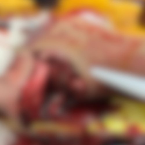 Imagem forte: trabalhador tem o pé quase decepado por roçadeira em seringal no Acre