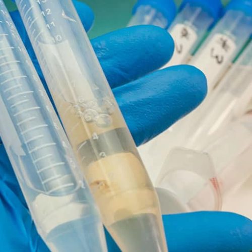 Criança de 7 anos é diagnosticada com meningite em Cruzeiro do Sul