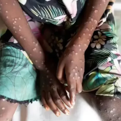 Amazonas confirma 33 casos de Mpox em 2025; todos são homens