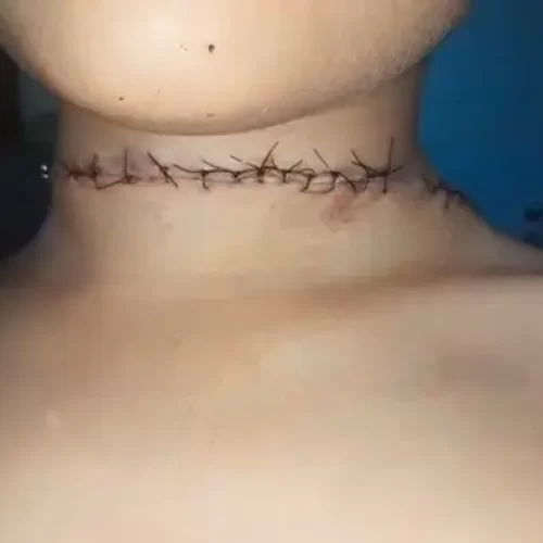 Menino de 6 anos leva 20 pontos no pescoço após ser ferido por linha de pipa com cerol