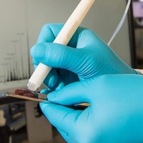 Caneta que detecta câncer em segundos é testada pela 1ª vez no Brasil