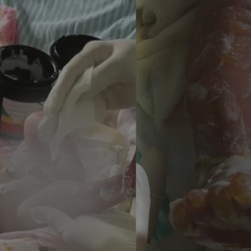 Recém-nascida sofre queimaduras em maternidade do Acre e família denuncia negligência