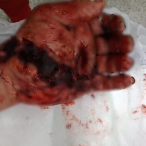 Ribeirinho sofre grave acidente com motosserra e quase perde a mão na comunidade Três Unidos