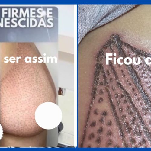 Manciolimense queimada em procedimento estético contesta versão da profissional: “Fiz além do que foi orientado”