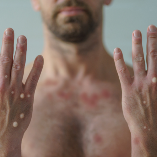 Governo do Acre confirma caso importado de Mpox em Brasileia e vigilância é reforçada