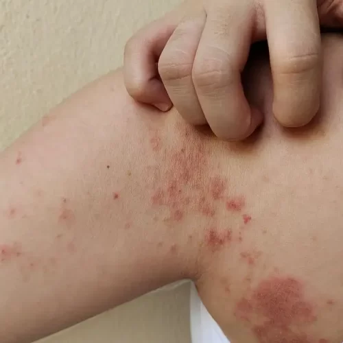 Em menos de 5 meses, Acre registra 150 novos casos de hanseníase e alerta inclui crianças