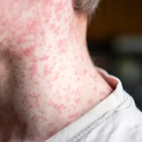 Acre investiga casos suspeitos de sarampo em quatro cidades